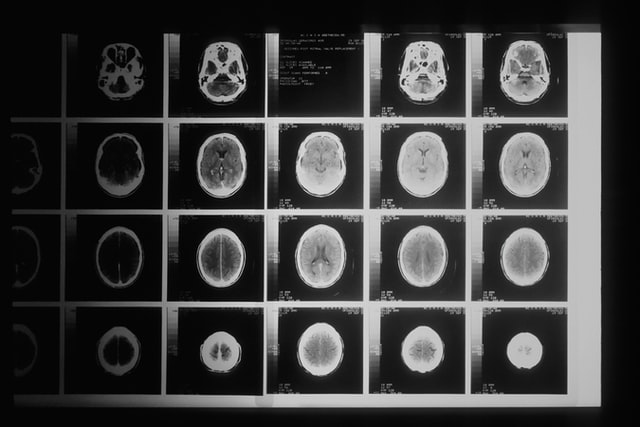 Brain CT Scan