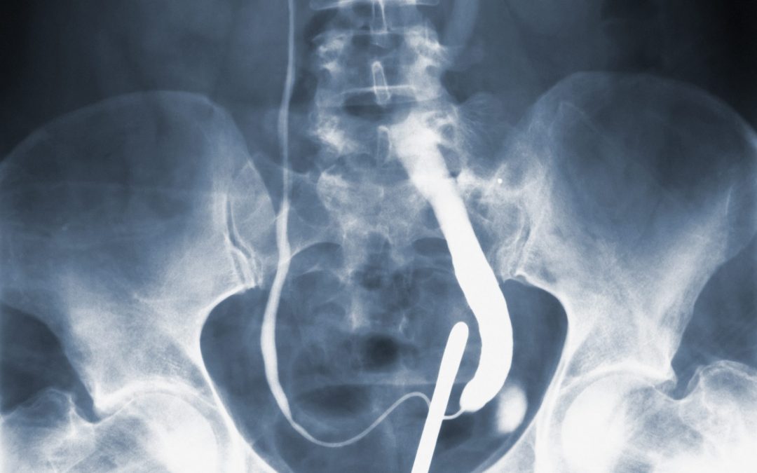 Pelvis x ray: Purpose, preparation & Procedure